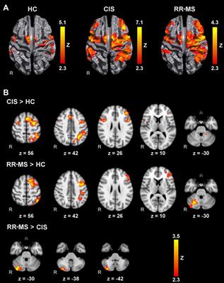 Motor Imagery as a Function of Disease Severity in Multiple Sclerosis: An fMRI Study